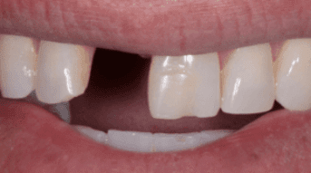 DENTAL IMPLANTS TRANSFORMATIONS