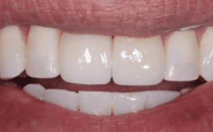 DENTAL IMPLANTS TRANSFORMATIONS