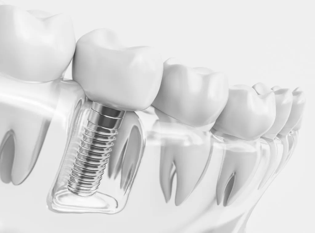 Dental Implants