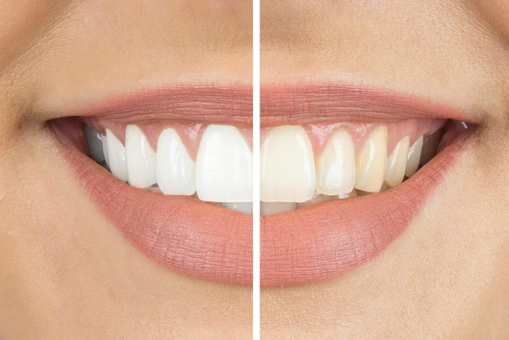how much is teeth whitening uk