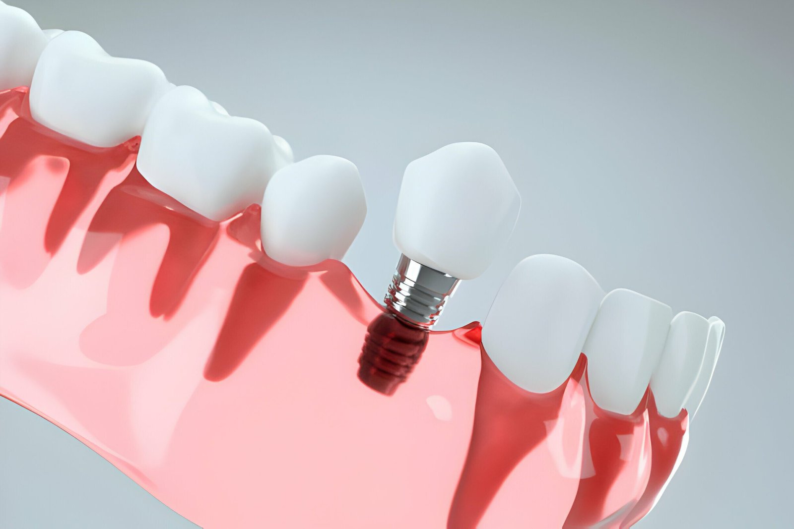 Dental Implants