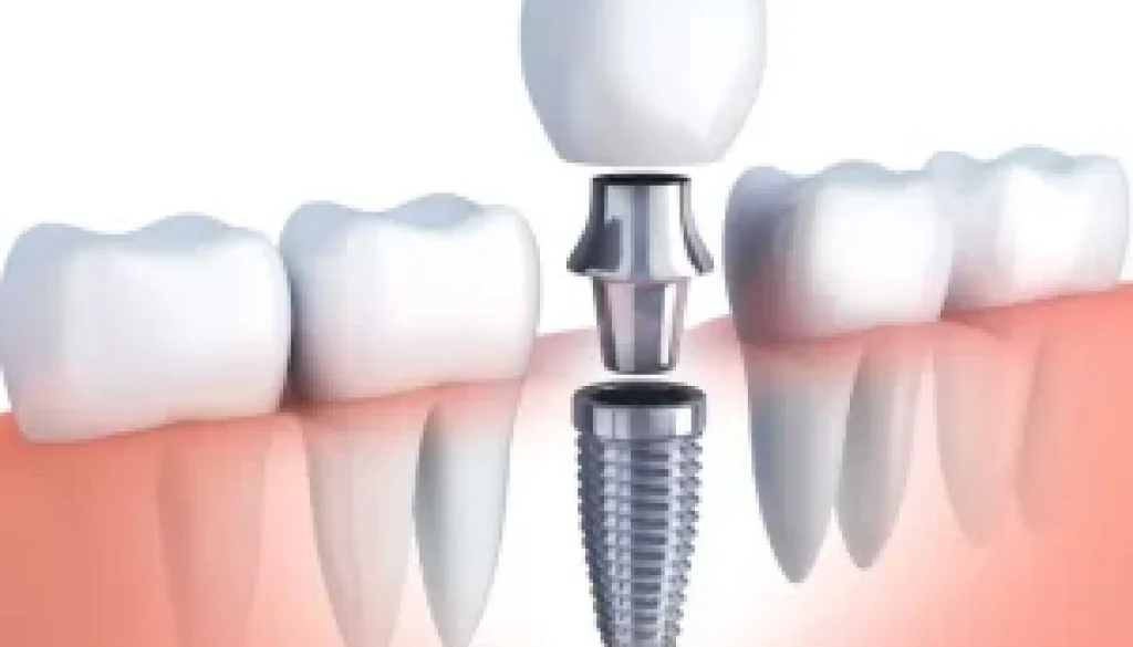 Dental Implants