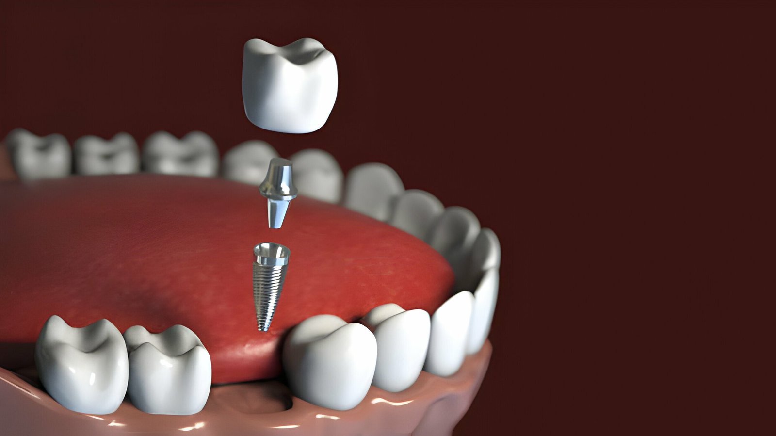 Dental Implants