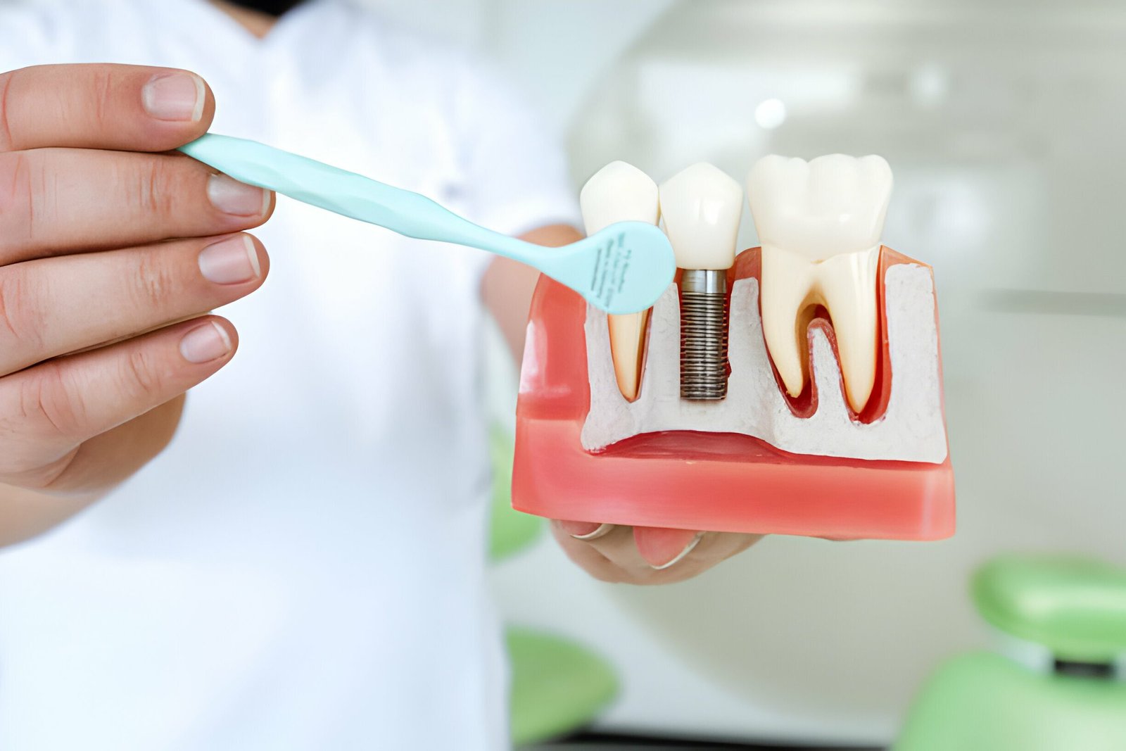 Dental Implants