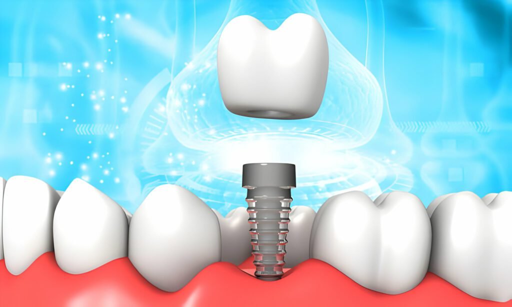 Dental Implants