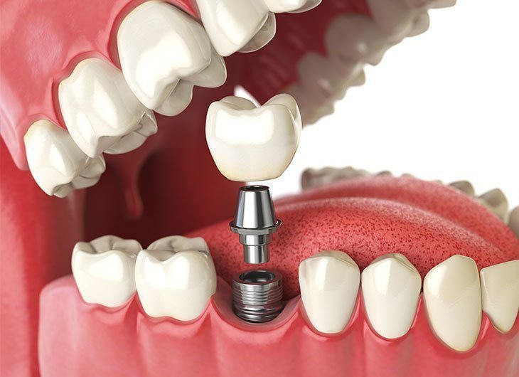 Dental implants