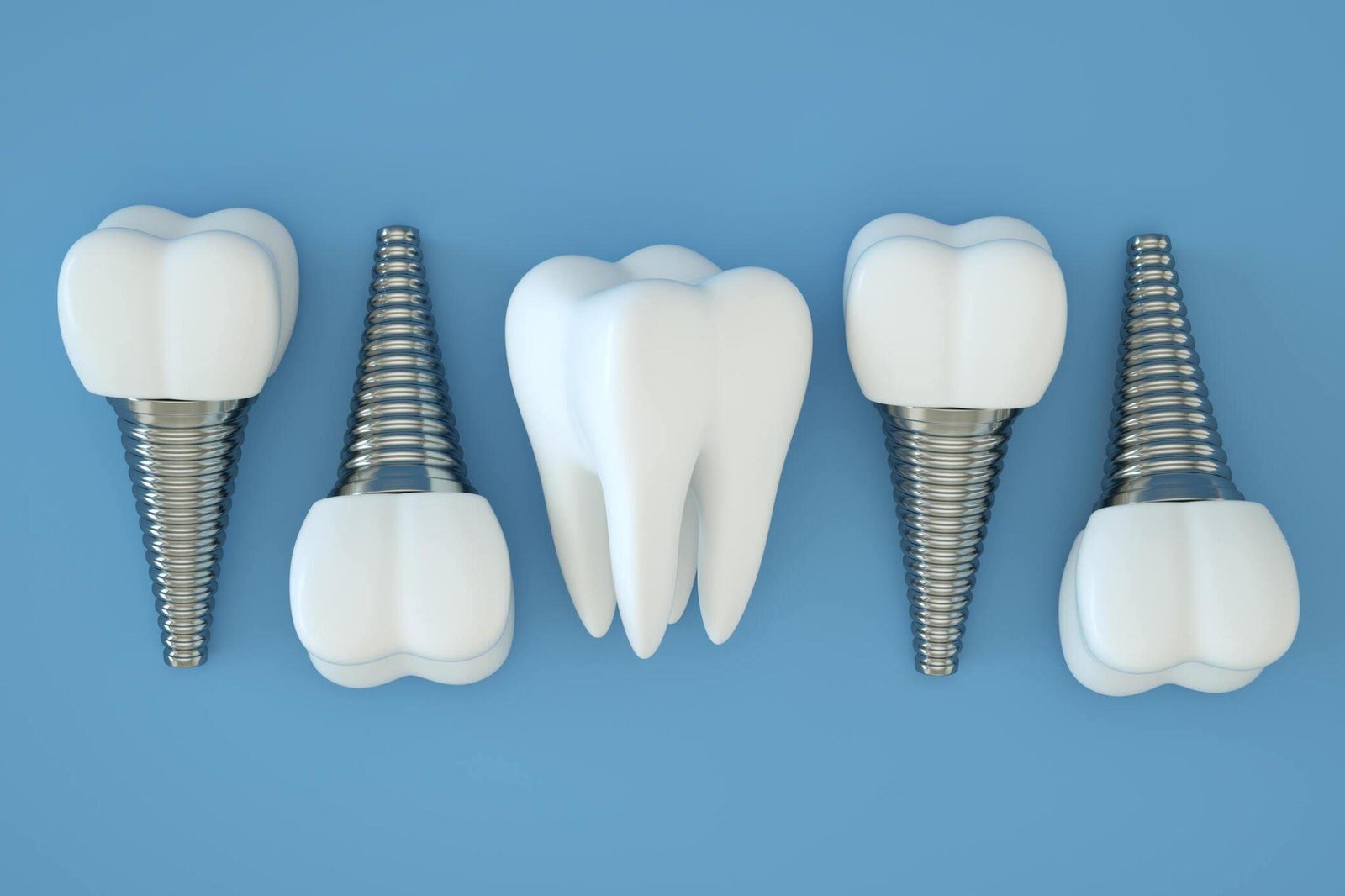 Dental Implants