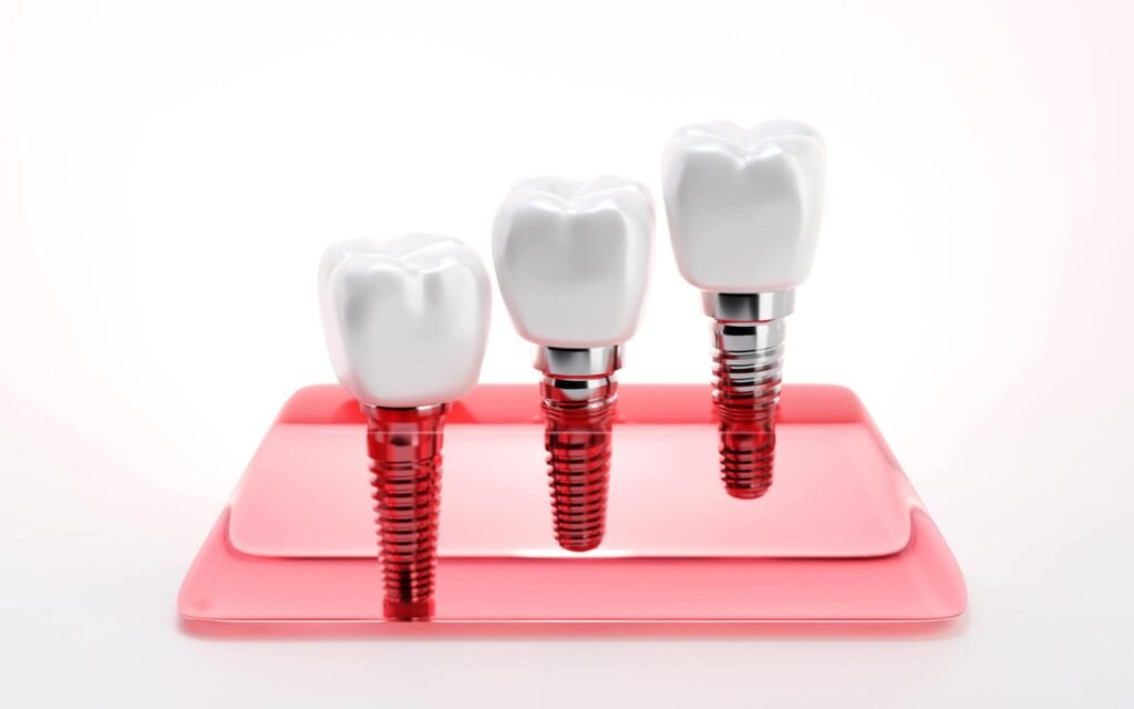 Dental Implants