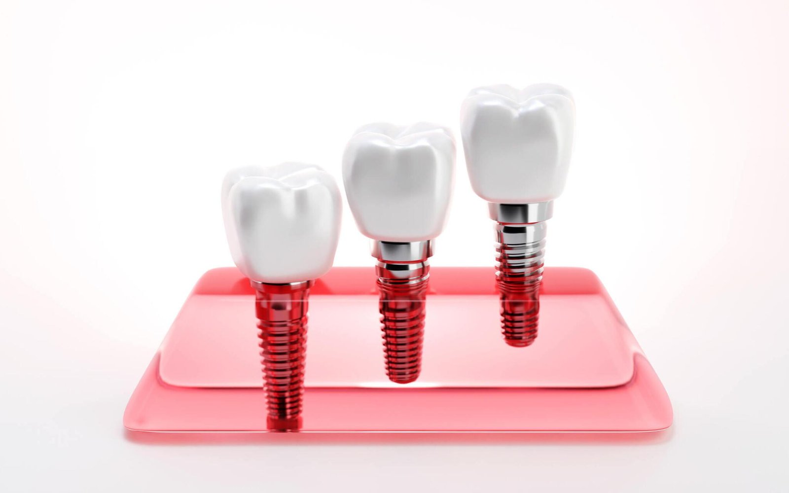 Dental Implants
