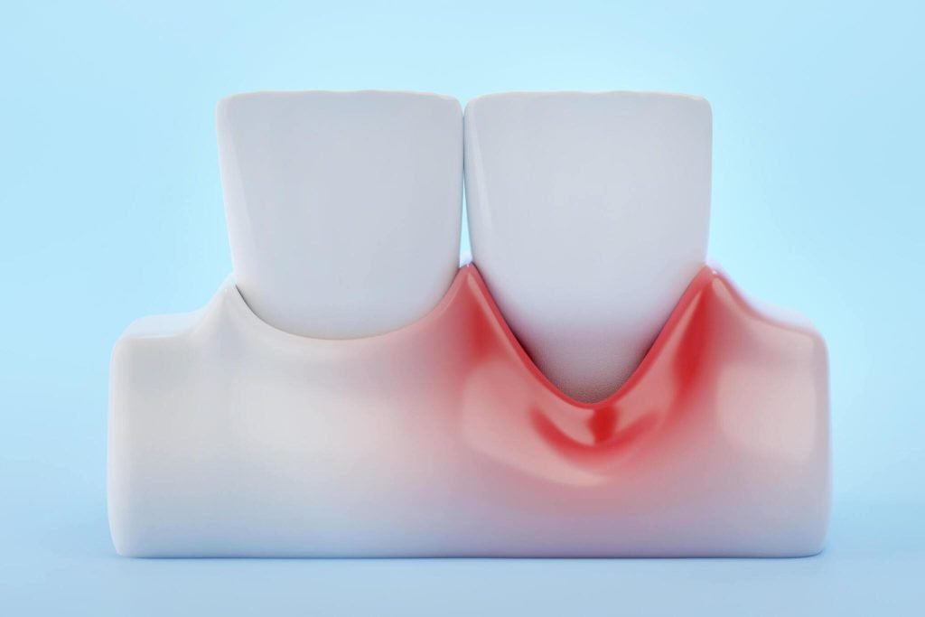 Dentures Receding Gums