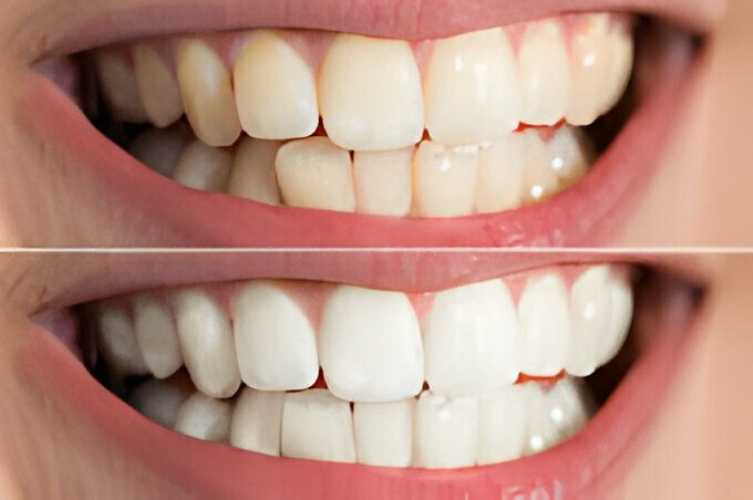 Composite Bonding Aberdeen | Old Town Dental Care