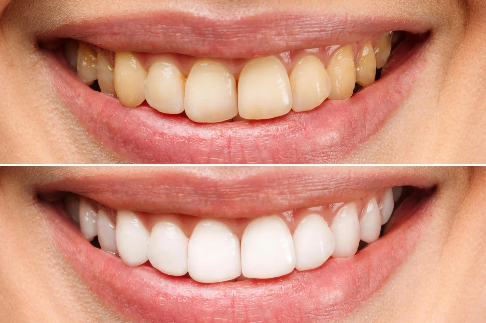 COMPOSITE BONDING TRANSFORMATIONS