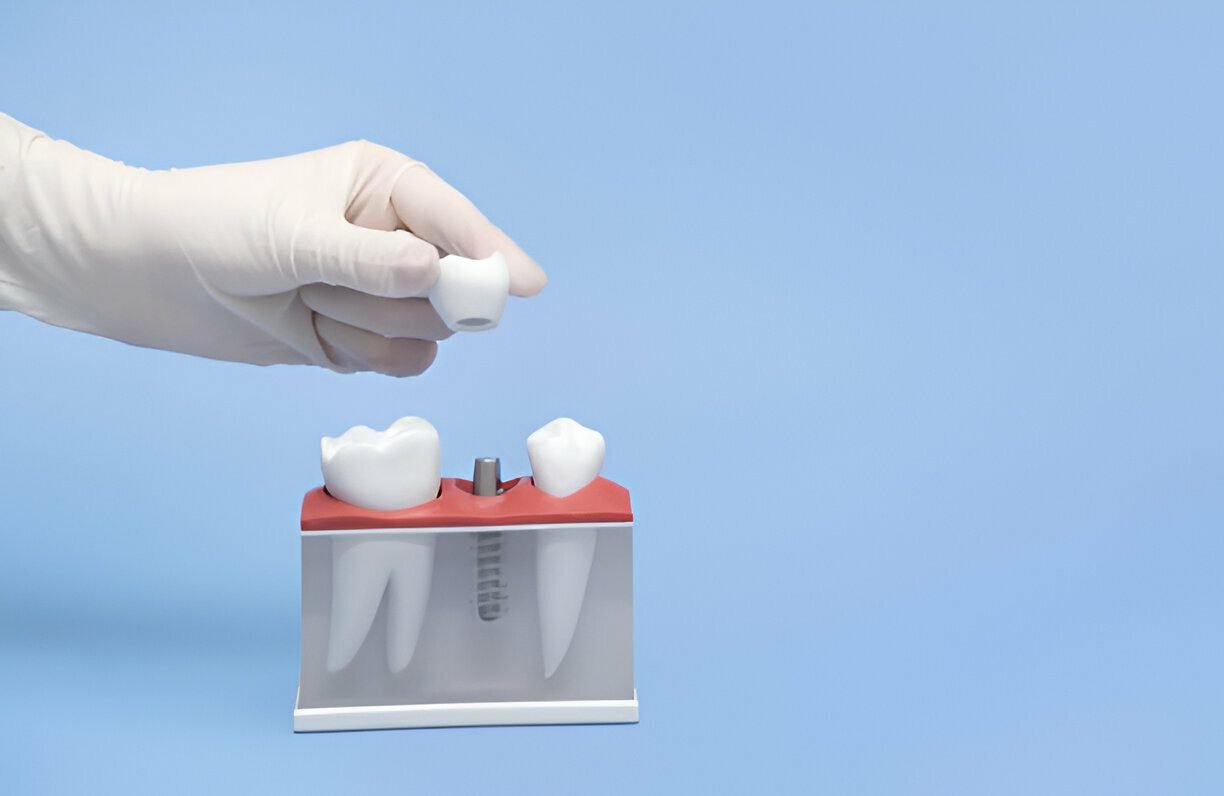 Dental Implants