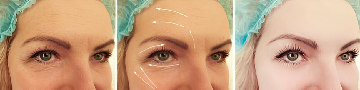 Botox
