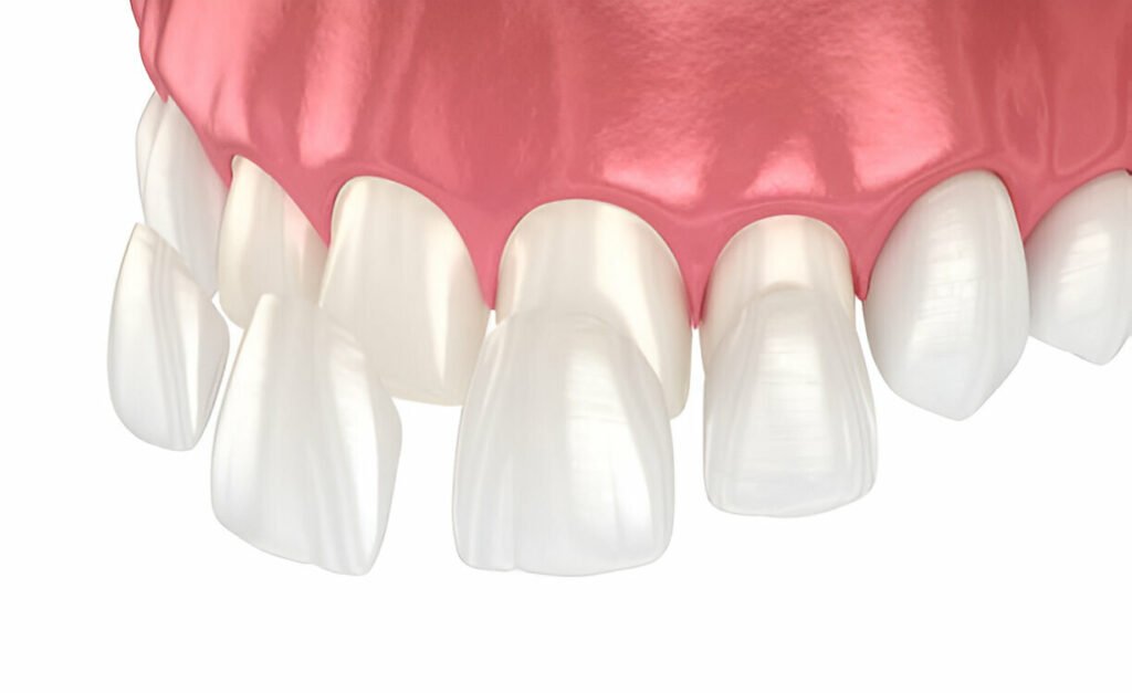 Composite Bonding