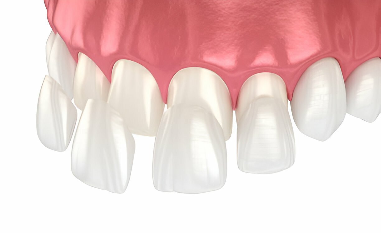 Composite Bonding
