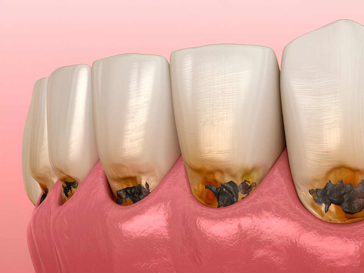 Peri-Implantitis