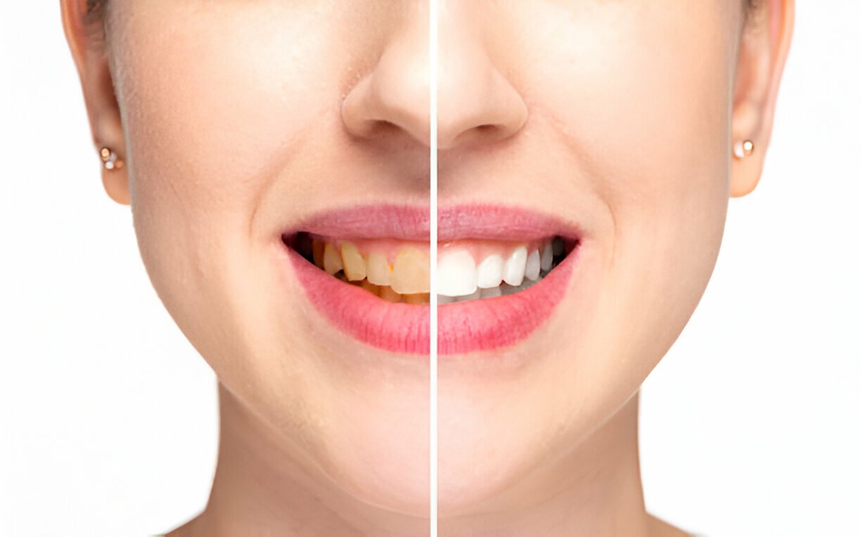 Teeth Whitening