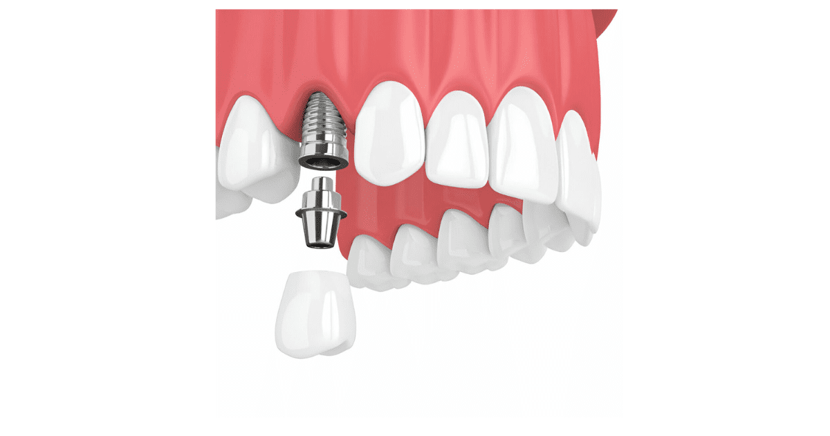 Dental Implants