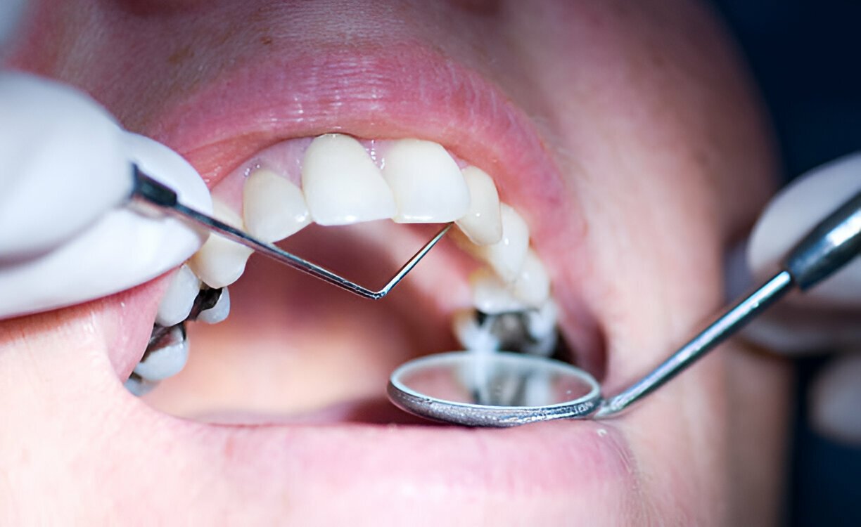 Dental Filling