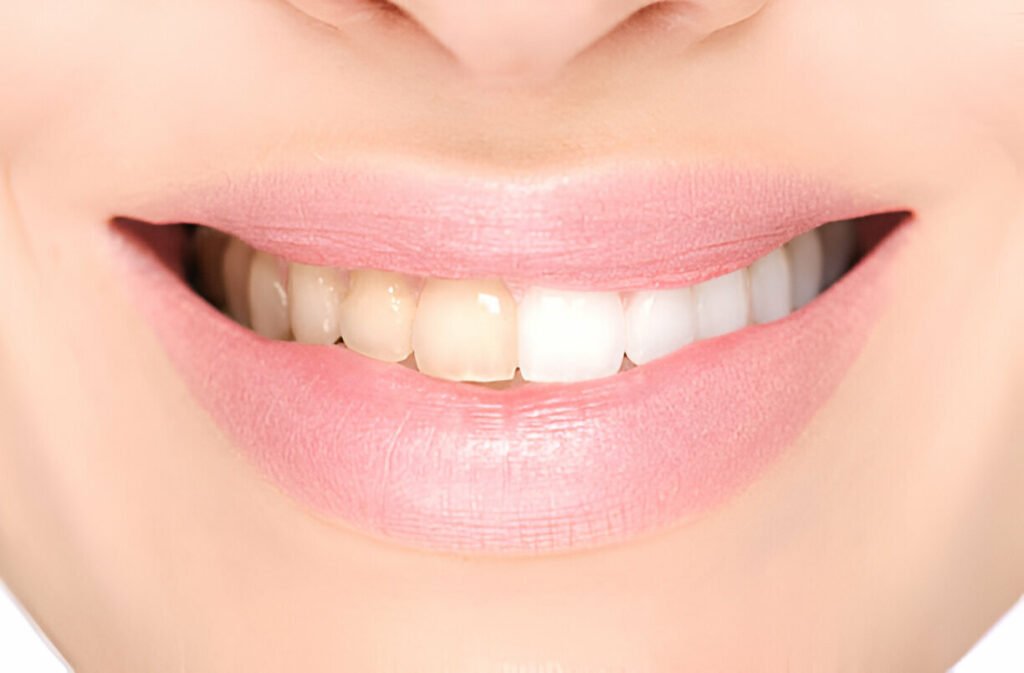 Teeth Whitening