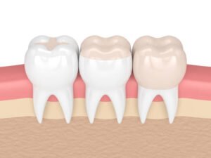 Composite Fillings