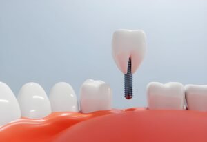 Dental Implants