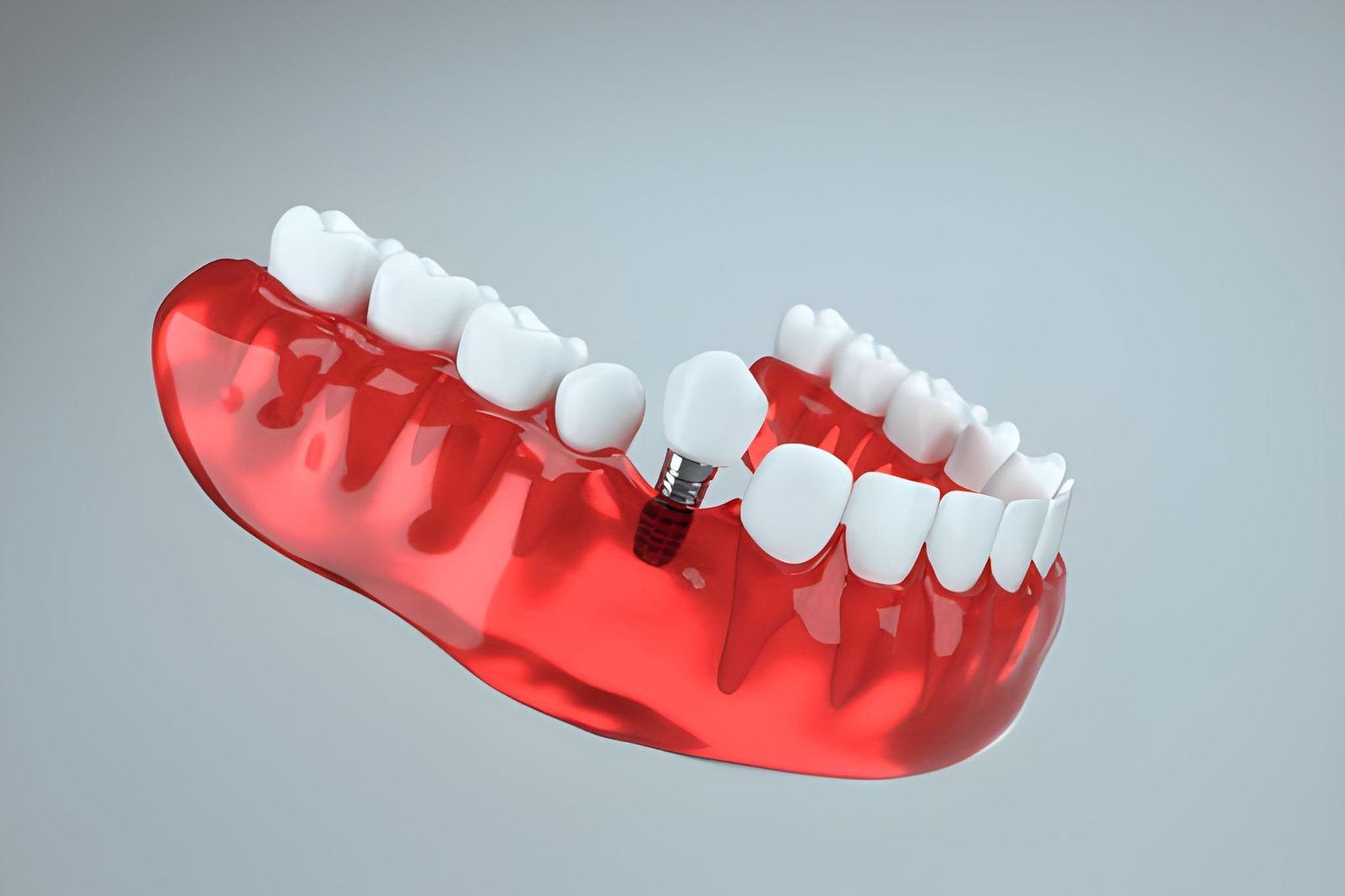 Dental Implants