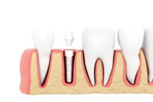 Dental Implants
