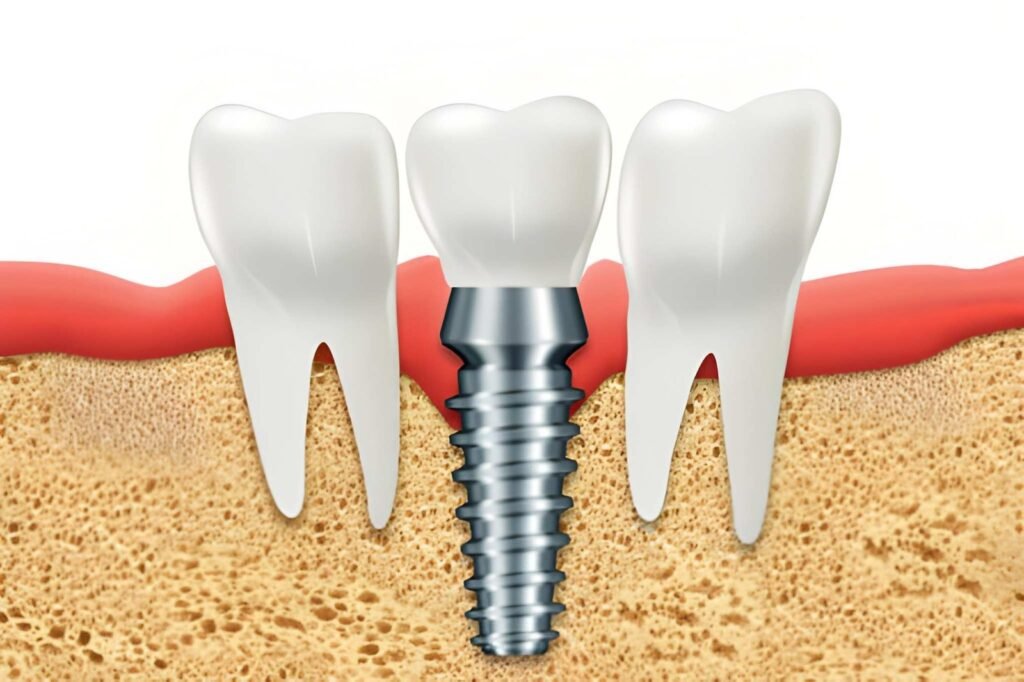 Dental Implant
