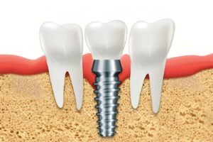 Dental Implant