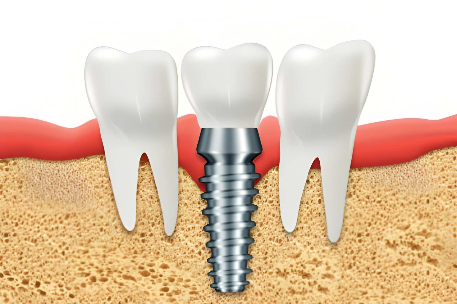 Dental Implant