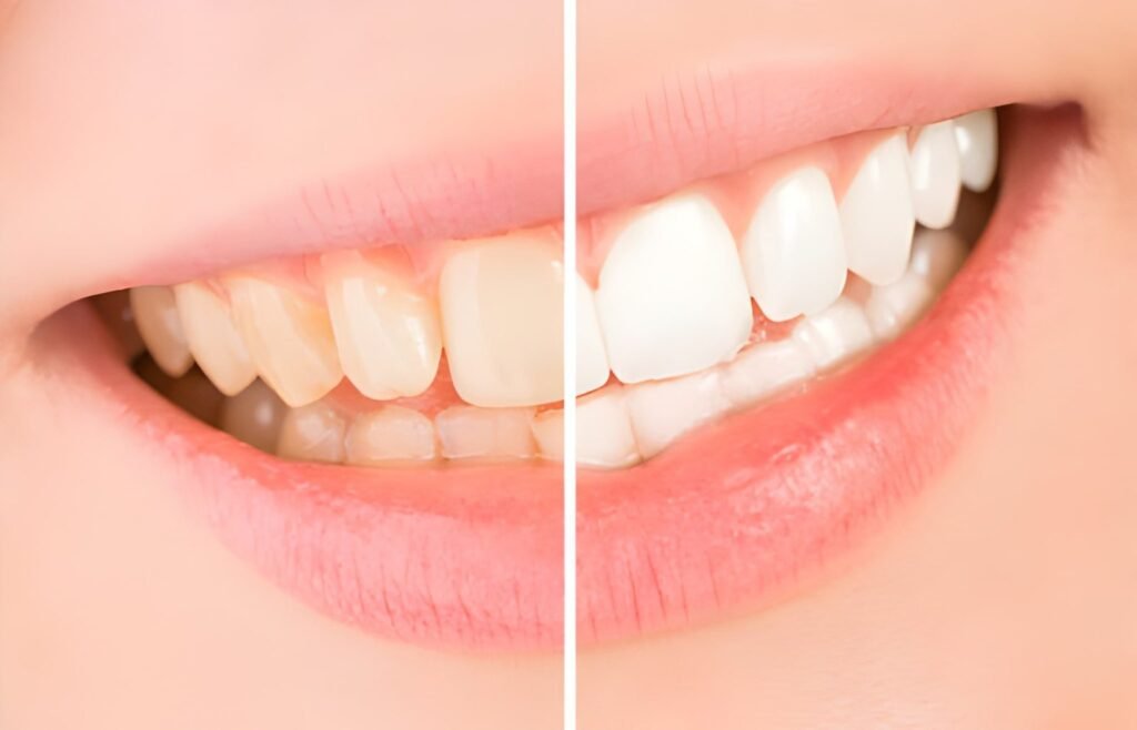 Teeth Whitening