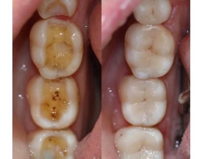 Dental Inlays and Onlays Aberdeen | Old Town Dental Care