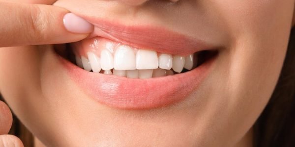 Oral Hygeine